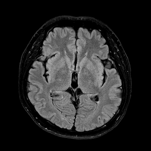 파일:body04 037 t2 flair ax.jpg